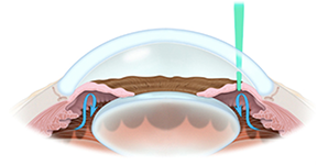 レーザー虹彩切開術（LI）