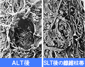 選択的レーザー線維柱帯形成術（SLT）