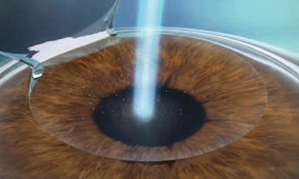 LASIK