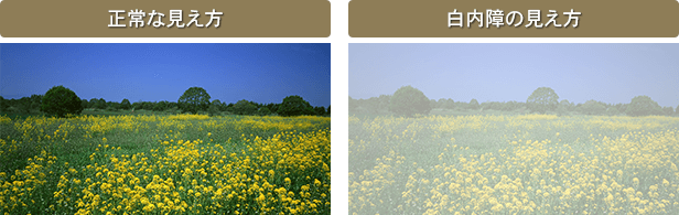白内障の見え方
