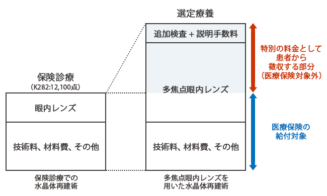 多焦点眼内レンズを使用した白内障手術の費用